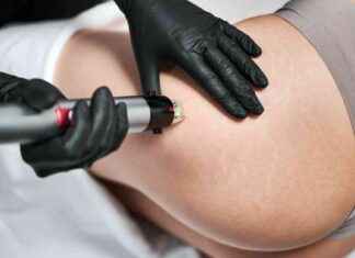 Tutto sulla cellulite: caratteristiche, cause e cure news-24092024-055028